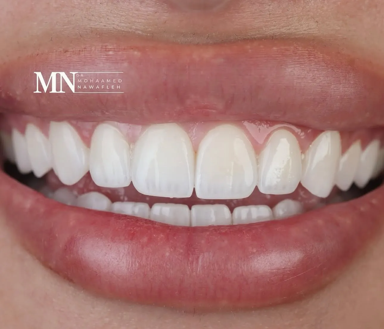 كيف تختار لون وشكل الأسنان المناسب لملامح وجهك؟