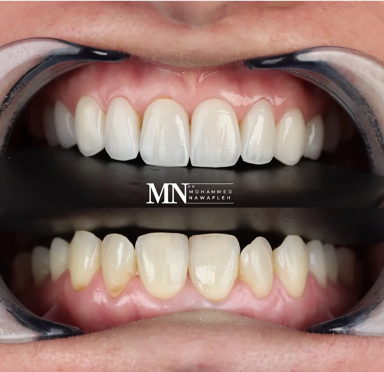 أسباب اصفرار الأسنان وأفضل طرق التخلص منه